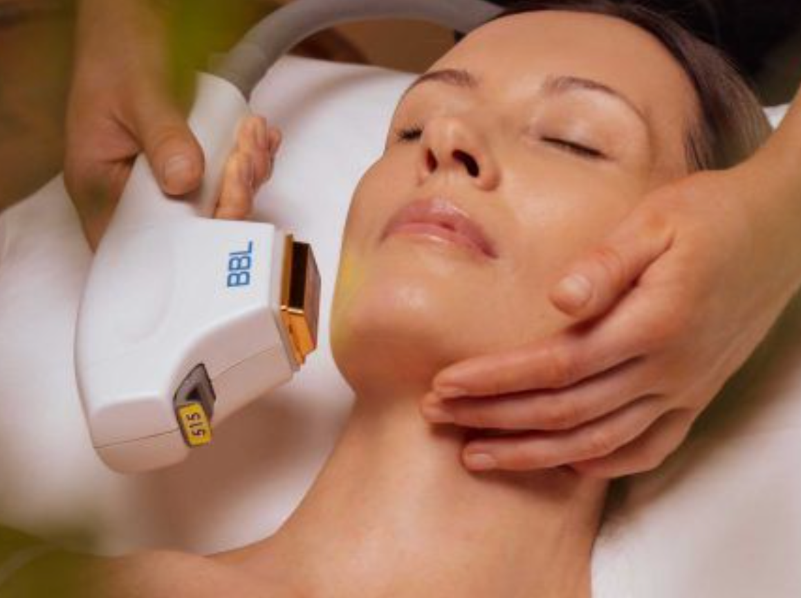 Forever Young BBL Treatment of the Face